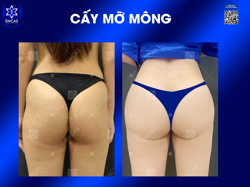 Cấy Mỡ Tự Thân Là Gì? Có Nên Thực Hiện Không?