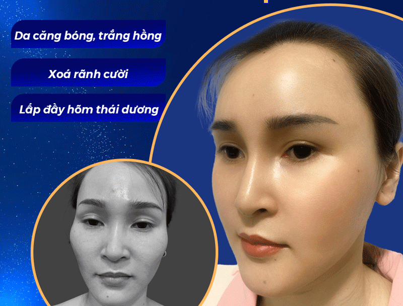 Cấy Mỡ Tự Thân Là Gì? Có Nên Thực Hiện Không?