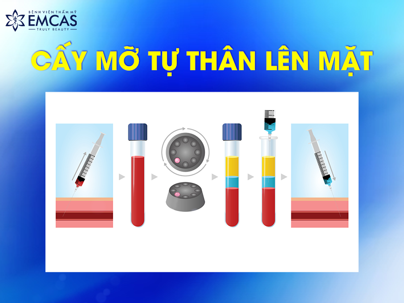 Quy Trình Cấy Mỡ Tự Thân Lên Mặt