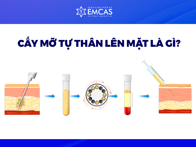 Cấy Mỡ Tự Thân Lên Mặt Giá Bao Nhiêu