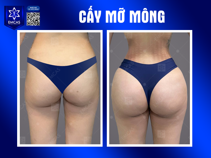 Cấy Mỡ Tự Thân Nâng Mông Có Giữ Được Lâu Không?