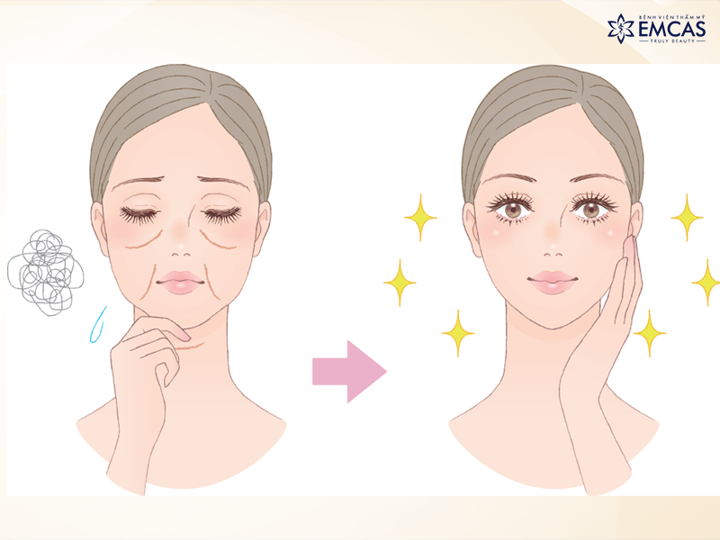 Cấy Mỡ Tự Thân Có Được Vĩnh Viễn Hay Không