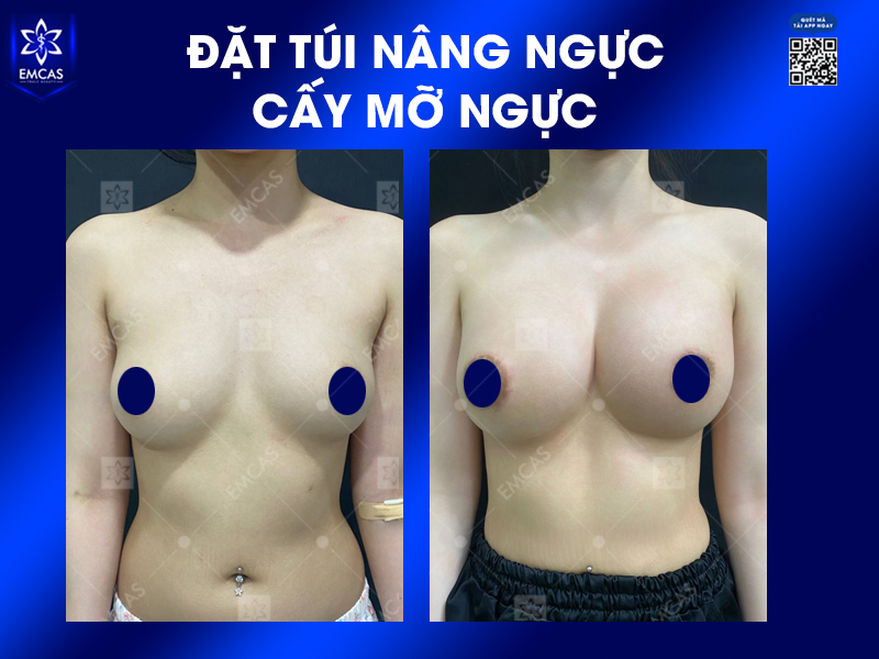 Cấy Mỡ Tự Thân Là Gì? Có Nên Thực Hiện Không?