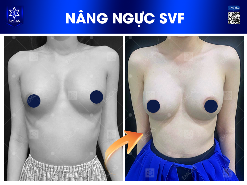 Làm Đẹp Tự Nhiên Với Phương Pháp Nâng Ngực SVF