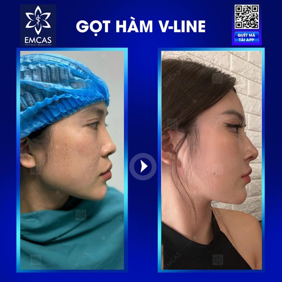 GỌT HÀM