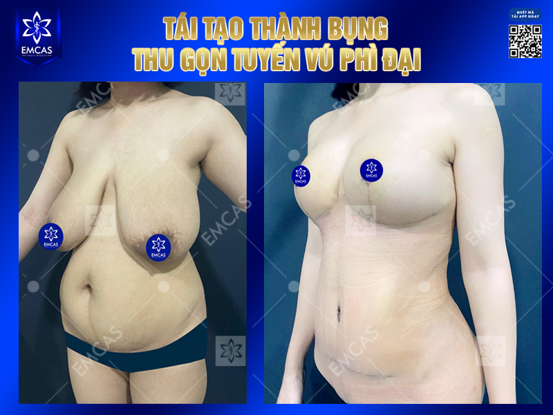 Ưu Điểm Của Phương Pháp Tái Tạo Thành Bụng