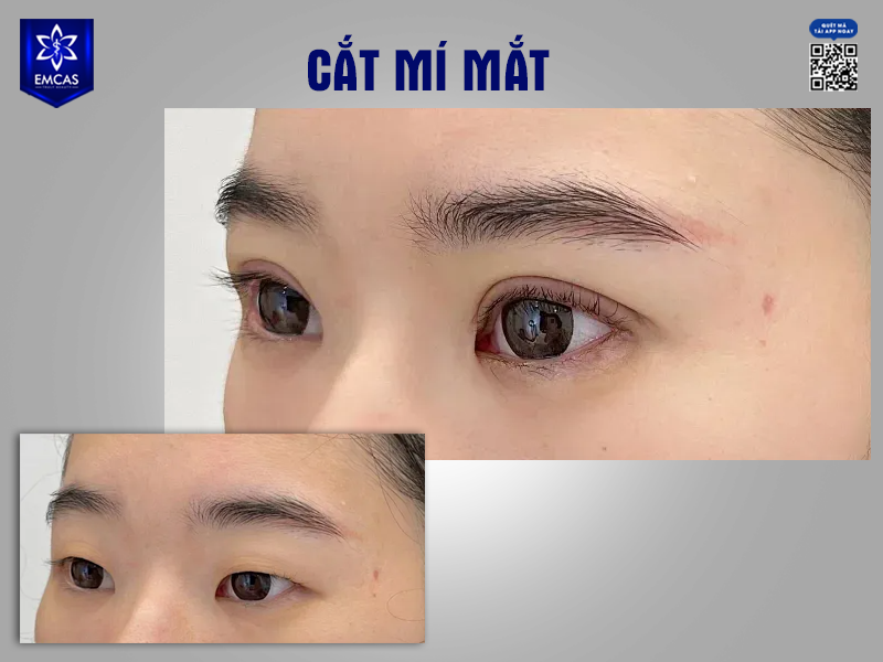 Chăm sóc sau phẫu thuật cắt mí