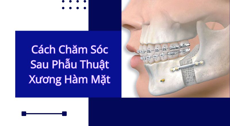 Cách Chăm Sóc Sau Phẫu Thuật Xương Hàm Mặt Theo Chỉ Dẫn Của Bác Sĩ