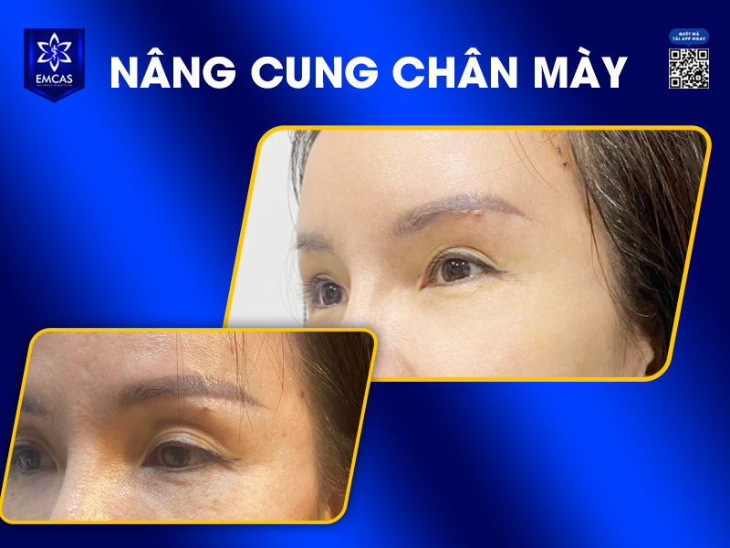 Nâng Cung Chân Mày Là Gì?