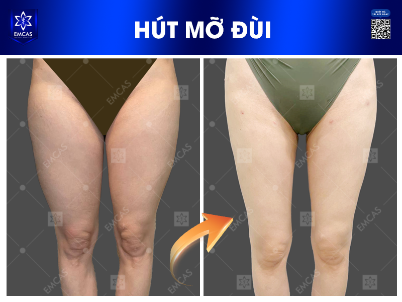 Lấy Lại Đôi Chân Thon Gọn Bằng Dịch Vụ Hút Mỡ Đùi