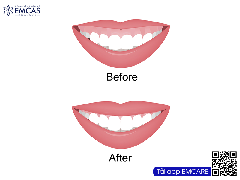 CHỮA CƯỜI HỞ LỢI – GUMMY SMILE
