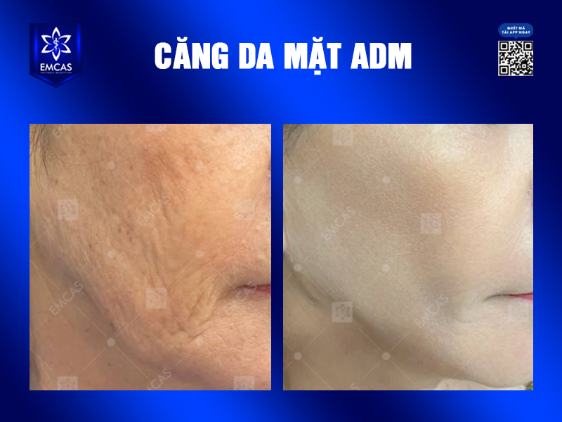 Căng Da Mặt ADM Có Thật Sự Hiệu Quả Trong Việc Trẻ Hóa Khuôn Mặt?