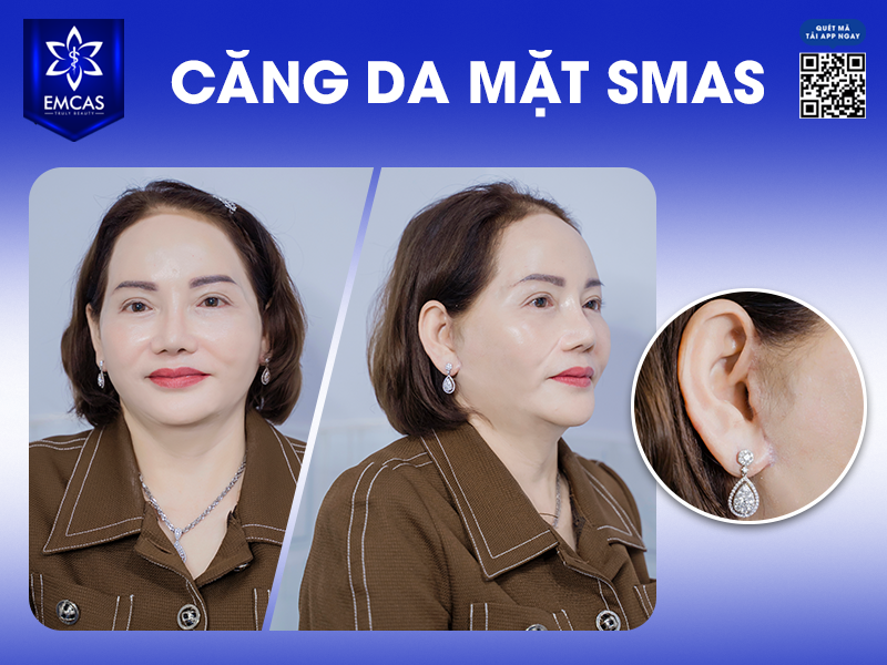 Làm Thế Nào Để Giúp Kéo Dài Hiệu Quả Căng Da Mặt?