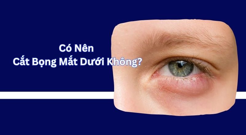 Có Nên Cắt Bọng Mắt Dưới Không?