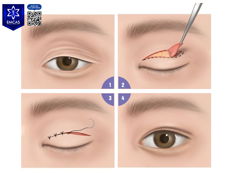 Cắt Mí Có Để Lại Sẹo Không? Cách Chăm Sóc Để Mí Đẹp Tự Nhiên