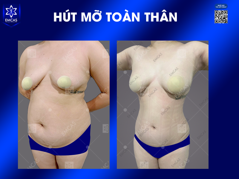 Hút Mỡ Toàn Thân Là Gì? Có Nên Hút Mỡ Toàn Thân?