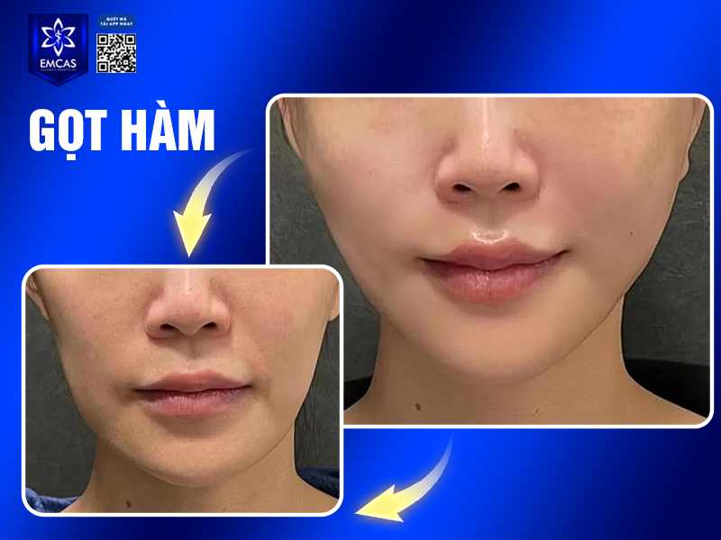 Có Nên Gọt Hàm Hay Không? Phương Pháp Này Có An Toàn?