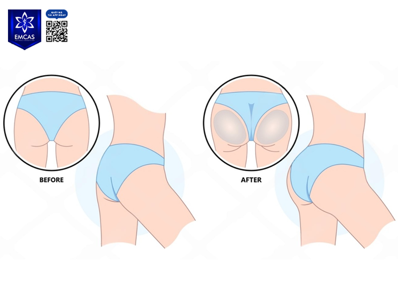 Đặt Túi Mông - Giải Pháp Nhanh Chóng Để Sở Hữu Vòng 3 Đầy Đặn