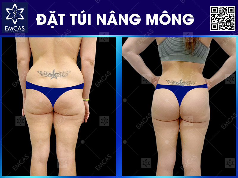 ĐẶT TÚI NÂNG MÔNG