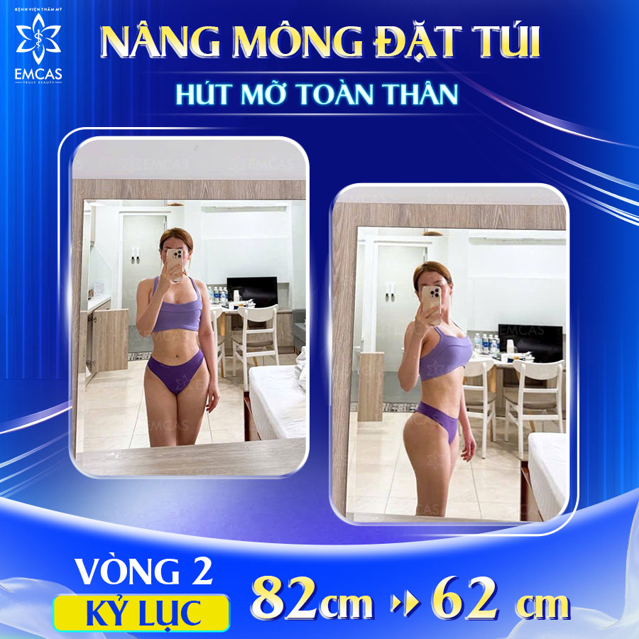 Nâng Mông Có Ảnh Hưởng Đến Việc Ngồi Hay Đi Lại Không?