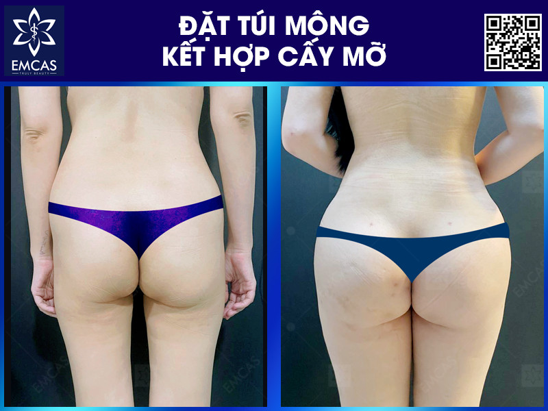 Cấy Mỡ Tự Thân Nâng Mông Có Giữ Được Lâu Không?
