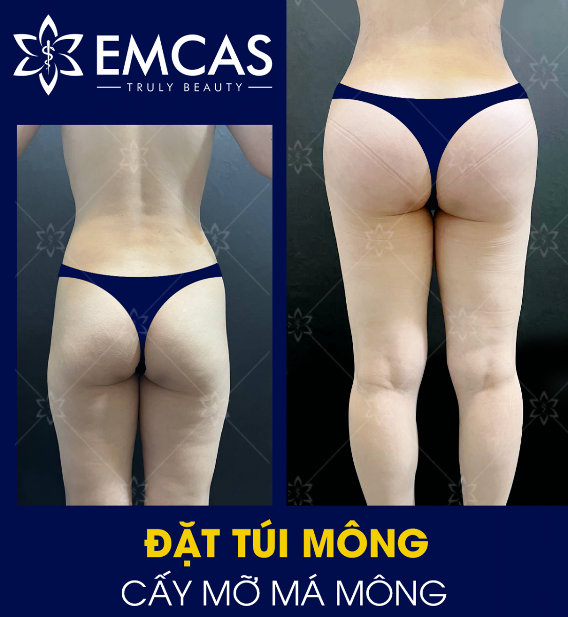 CẤY MỠ MÔNG