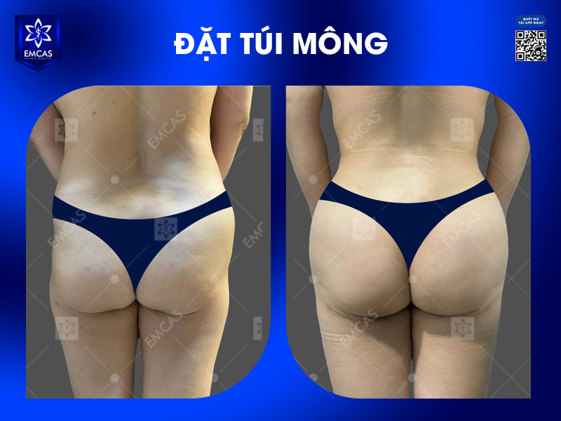 Nâng Mông Có Ảnh Hưởng Đến Việc Ngồi Hay Đi Lại Không?