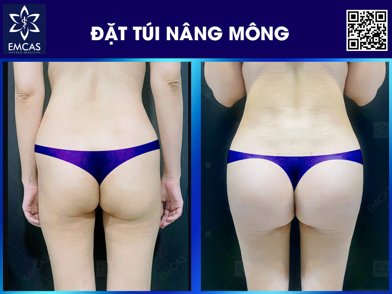 ĐẶT TÚI NÂNG MÔNG