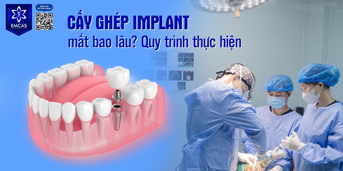CẤY GHÉP IMPLANT MẤT BAO LÂU? QUY TRÌNH THỰC HIỆN