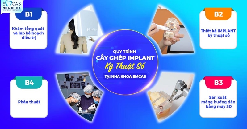Các giai đoạn cắm Implant được chia thành nhiều bước rõ ràng, từ thăm khám ban đầu, cấy trụ, gắn răng tạm cho đến lắp răng sứ hoàn chỉnh