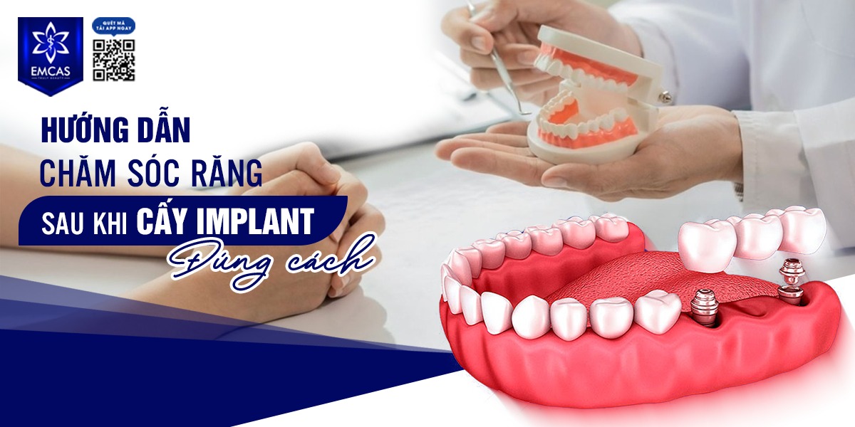 [HƯỚNG DẪN] CHĂM SÓC RĂNG SAU KHI CẤY IMPLANT ĐÚNG CÁCH