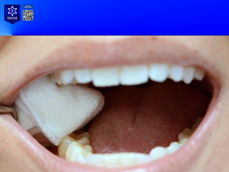 Ngay sau phẫu thuật, bạn sẽ được đặt một miếng bông gòn tại vùng cắm Implant