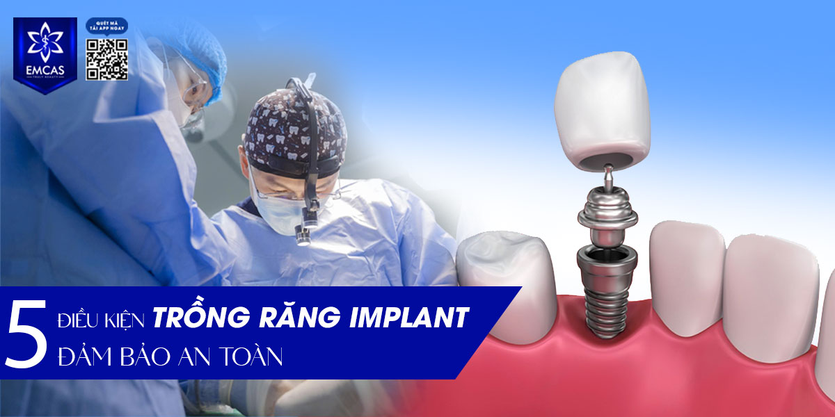 5 ĐIỀU KIỆN TRỒNG RĂNG IMPLANT ĐẢM BẢO AN TOÀN