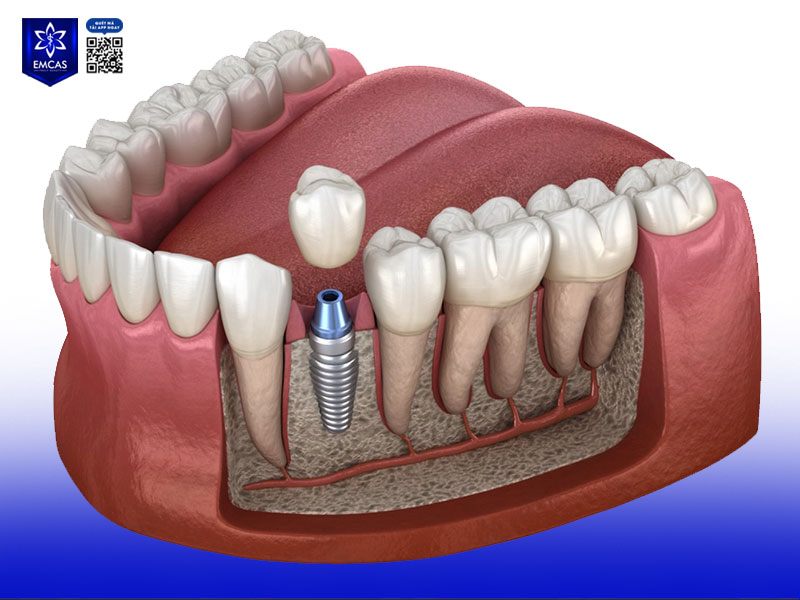Một trong những điều kiện trồng răng Implant quan trọng hàng đầu là có đủ mật độ và thể tích xương hàm