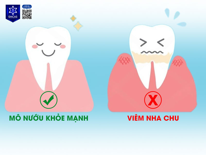 Để đảm bảo ca cấy ghép thành công, mô nướu khỏe mạnh, không viêm nha chu là một trong những điều kiện trồng răng Implant bắt buộc