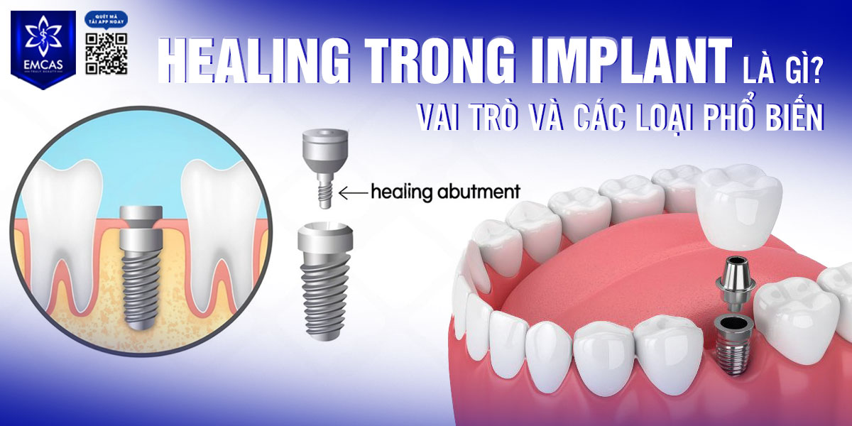 HEALING TRONG IMPLANT LÀ GÌ? VAI TRÒ VÀ CÁC LOẠI PHỔ BIẾN