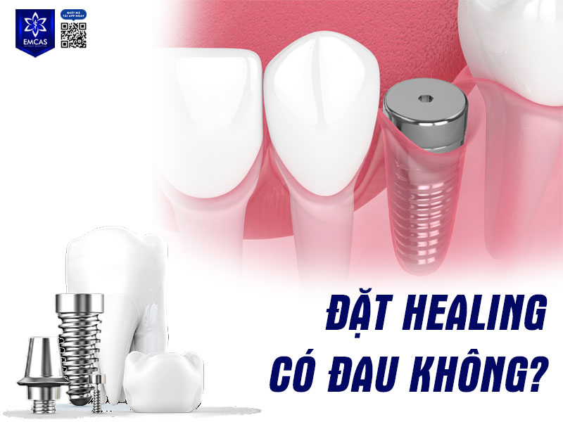 Quá trình đặt healing diễn ra khá nhanh và nhẹ nhàng, thường chỉ gây cảm giác ê nhẹ hoặc hơi khó chịu trong thời gian ngắn