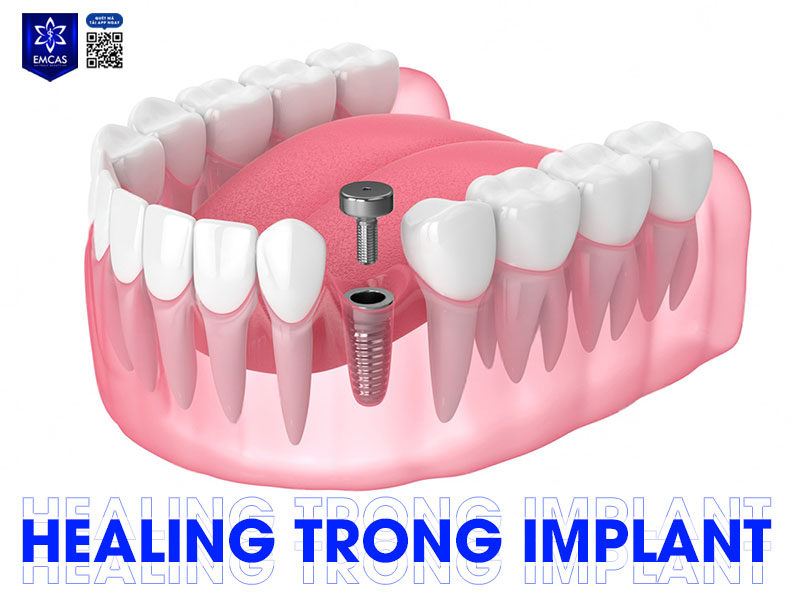Healing (trụ lành thương) đóng vai trò giúp định hình nướu và tạo điều kiện thuận lợi cho việc gắn mão răng sứ sau này
