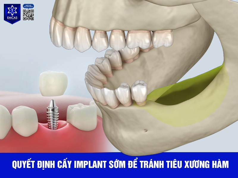 Nếu không cấy ghép trong vòng 6–12 tháng sau khi mất răng, xương hàm bắt đầu tiêu đi rõ rệt