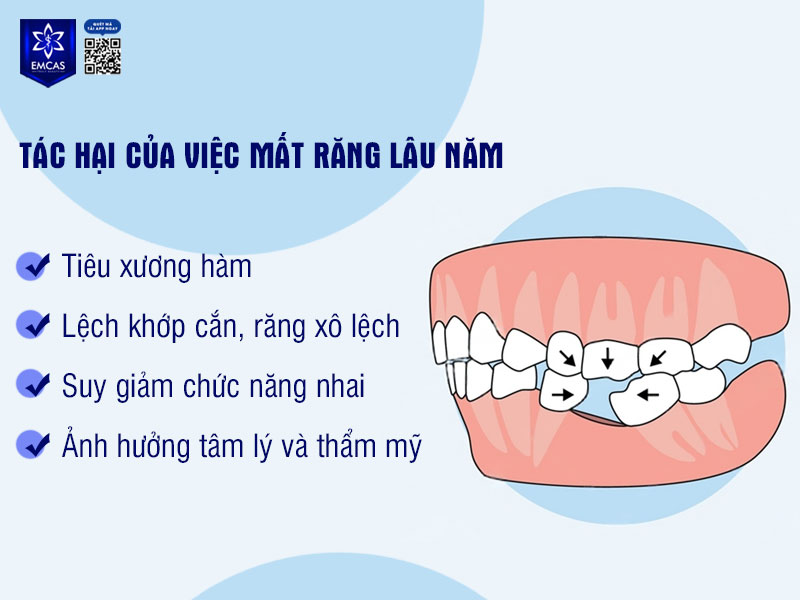 Mất răng không chỉ ảnh hưởng đến thẩm mỹ mà còn gây ra nhiều hệ lụy nghiêm trọng về sức khỏe răng miệng, cấu trúc xương hàm và chất lượng cuộc sống