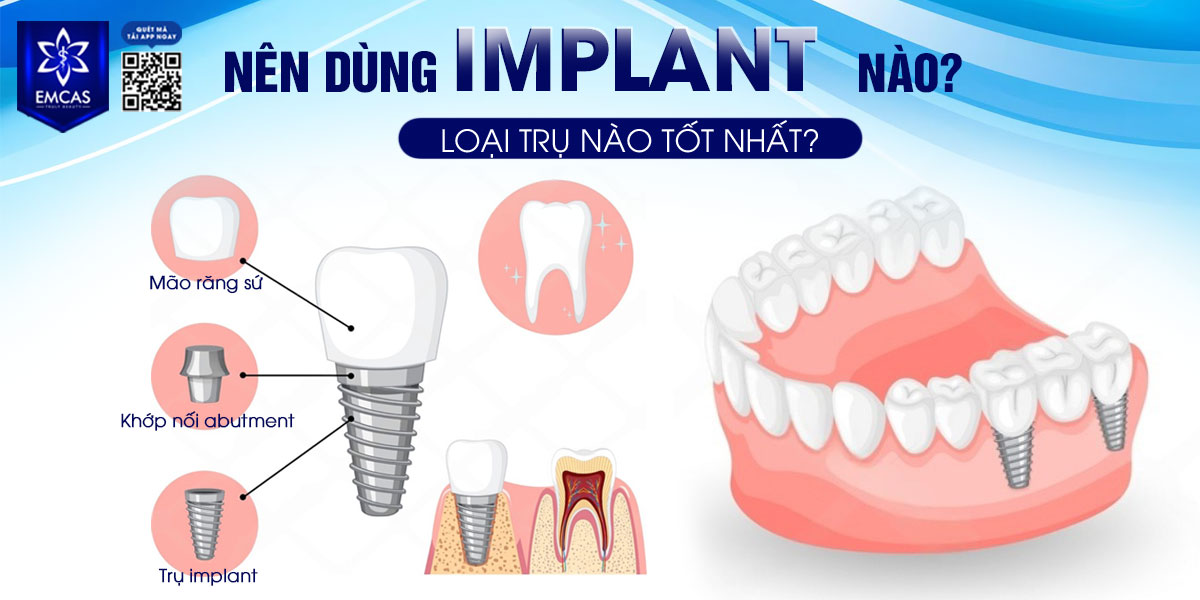 NÊN DÙNG IMPLANT NÀO? LOẠI TRỤ NÀO TỐT NHẤT?