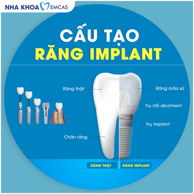 Trụ Implant là phần trụ nhỏ bằng Titanium được cấy vào xương hàm để thay thế chân răng đã mất, đóng vai trò nền tảng vững chắc cho răng sứ phía trên