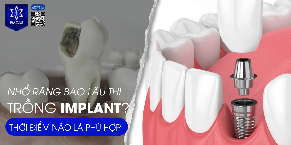 NHỔ RĂNG BAO LÂU THÌ TRỒNG IMPLANT? THỜI ĐIỂM NÀO LÀ PHÙ HỢP