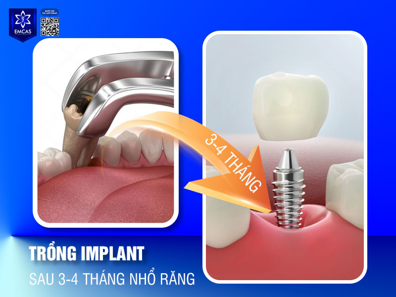 Khoảng thời gian sau 3-4 tháng nhổ răng cho phép xương hàm và mô mềm hồi phục hoàn toàn