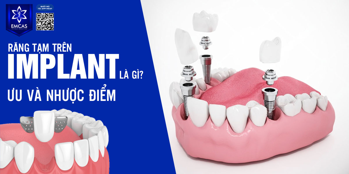 RĂNG TẠM TRÊN IMPLANT LÀ GÌ? ƯU VÀ NHƯỢC ĐIỂM