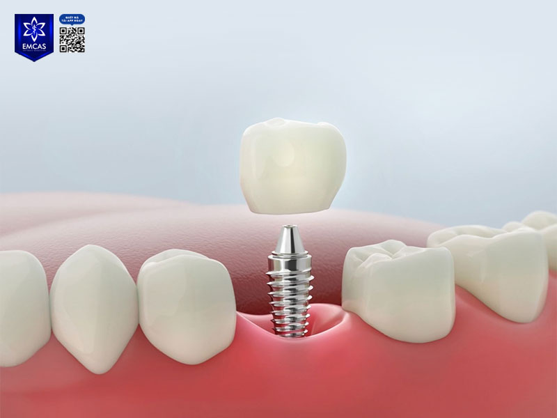 Răng tạm cố định có hình dáng giống răng thật, vừa khít với nướu và cho cảm giác nhai tương đối tự nhiên