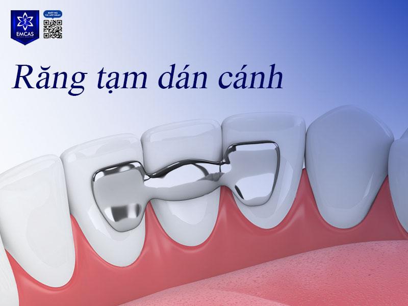 Răng tạm dán cánh được thiết kế với phần “cánh” nhỏ phía sau để dán cố định vào các răng kế cận