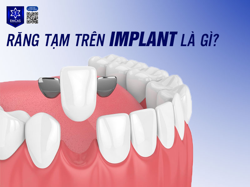 Răng tạm trên Implant là mão răng được gắn tạm thời lên trụ Implant trong thời gian chờ trụ tích hợp hoàn toàn với xương hàm