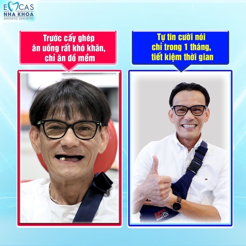 Trụ Implant được cấy trực tiếp vào xương hàm, có độ ổn định cao, không bị xô lệch như hàm giả tháo lắp