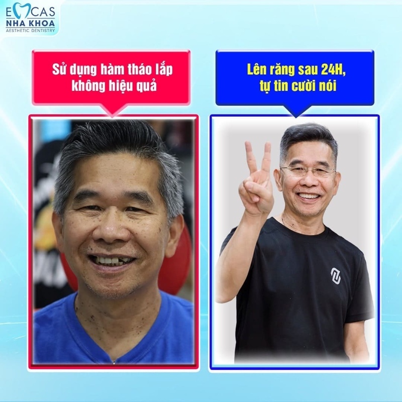 Khác với hàm giả tháo lắp chỉ nằm trên nướu, Implant kích thích xương hàm phát triển, ngăn tiêu xương